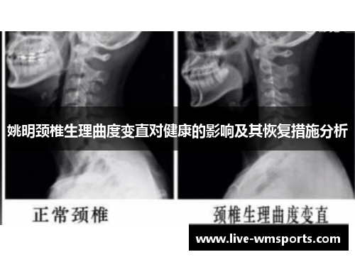 姚明颈椎生理曲度变直对健康的影响及其恢复措施分析